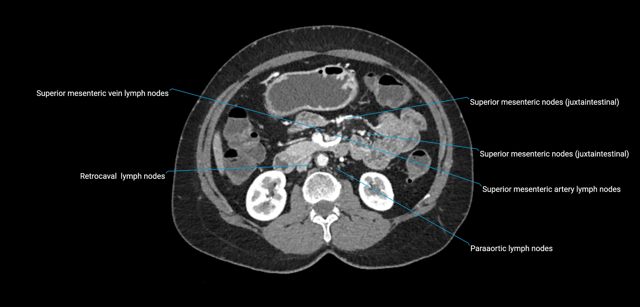 CT ct abdominal lymph nodes  axial cross sectional anatomy  enchanced radiology image -img-00002-00193.webp